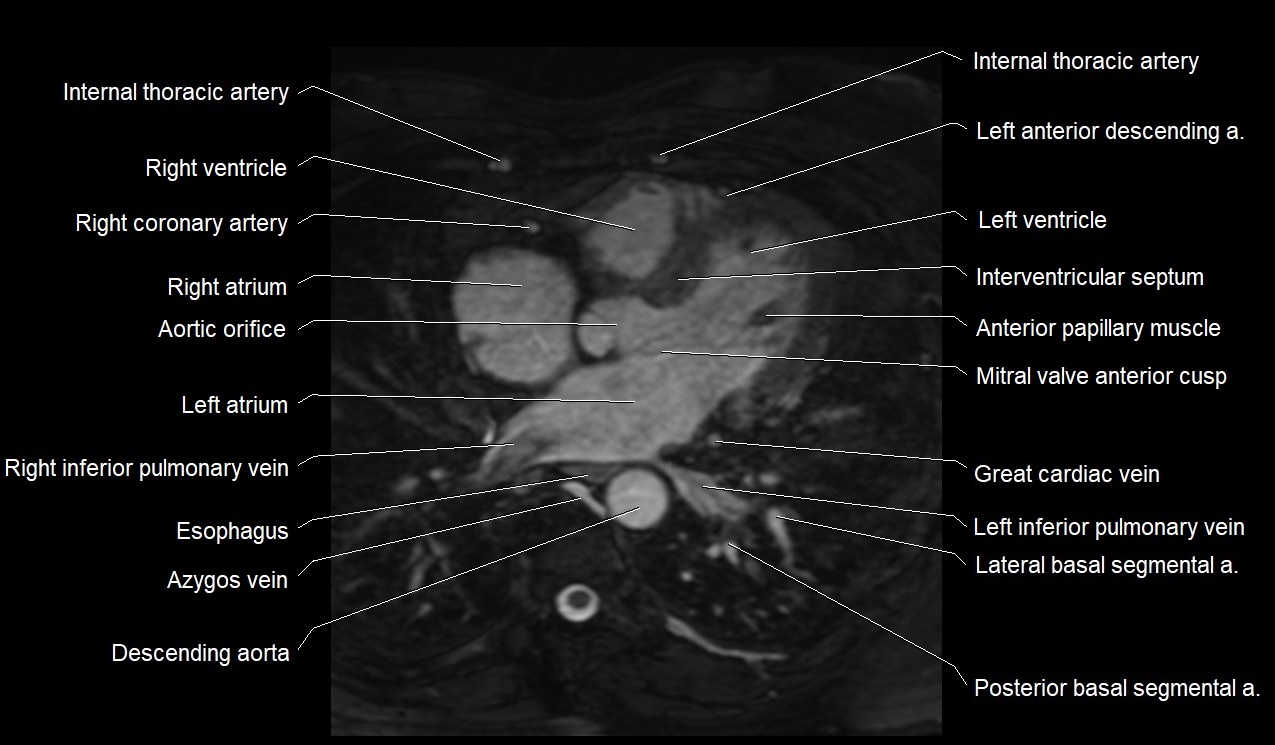 MRI heart coronary arteries and coronary veins anatomy axial image 24.jpg
